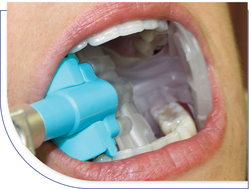 EZ DAM Dental Isolation System